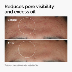 https://theordinary.com/dw/image/v2/BFKJ_PRD/on/demandware.static/-/Sites-deciem-master/default/dwcf135ad6/Images/products/The%20Ordinary/Before-After/ord-niacinamide-zinc-blemish-serum-before-after-pores.jpg